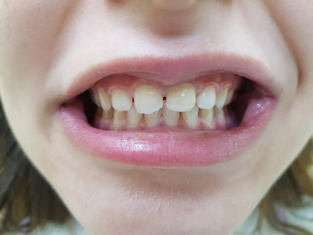 Before